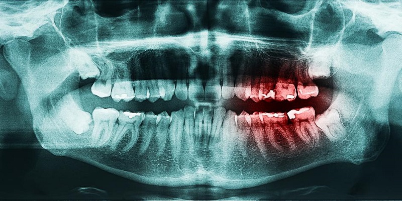 10 stvari koje se ljudima mogu dogoditi ako ne vole prati zube