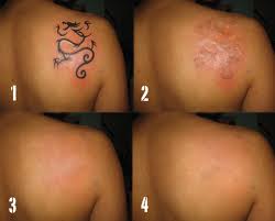 Uklanjanje tetovaže laserom